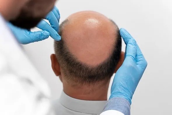 alopecia treatment