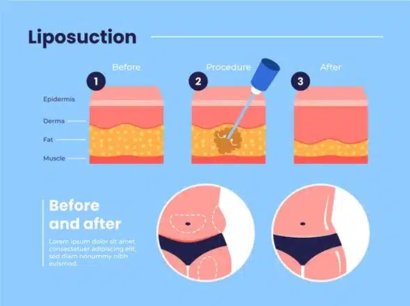 Liposuction procedure